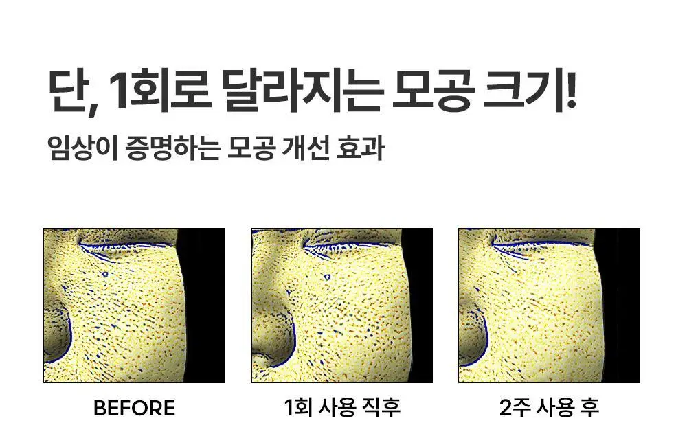 [모공임상] 프랭클리 모공축소 클로저 세럼 30ml 앰플 상세페이지 14